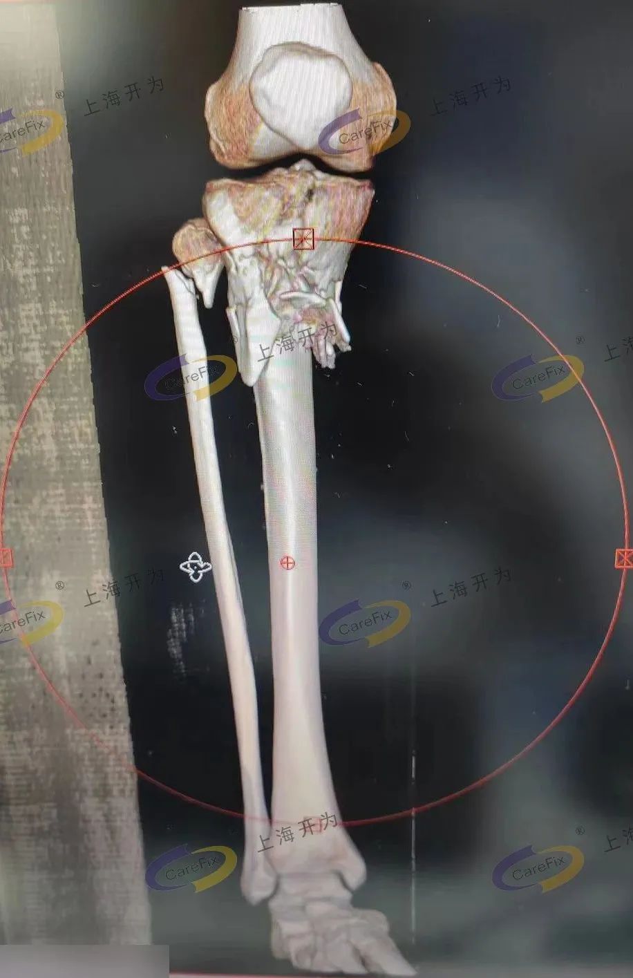 航亚科技获得实用新型专利授权：“人工膝关节假体胫骨托检测固定装置”