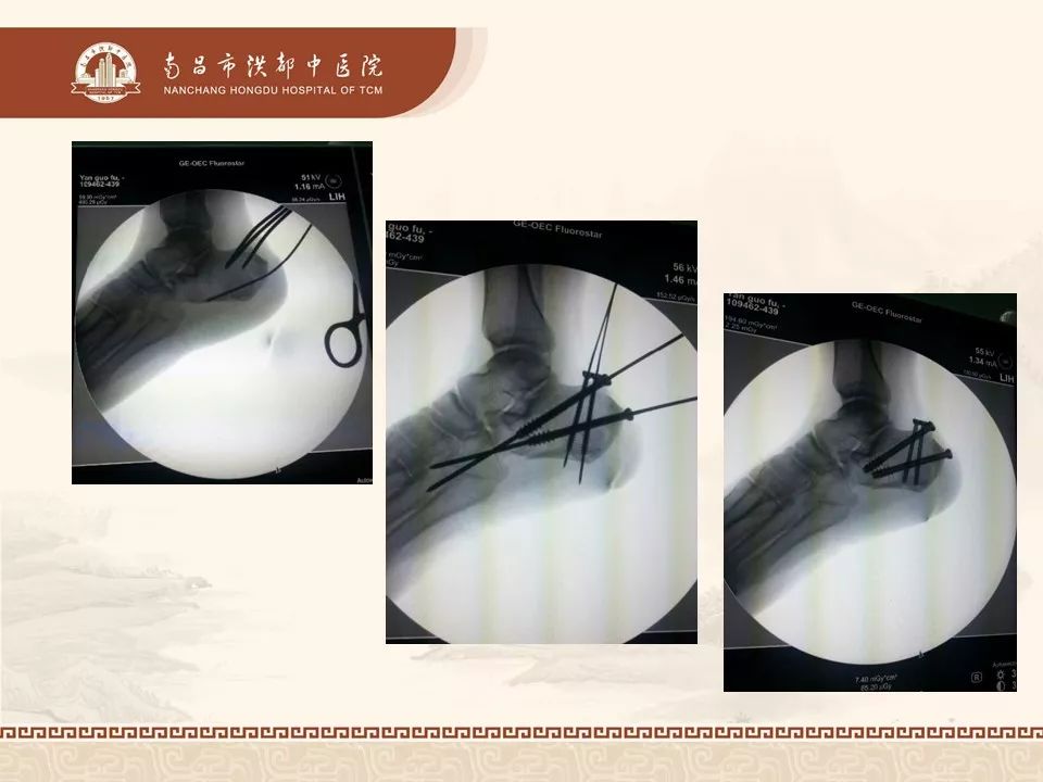 威高骨科获得发明专利授权：“一种用于跟骨置换的定制跟骨假体及制造方法”