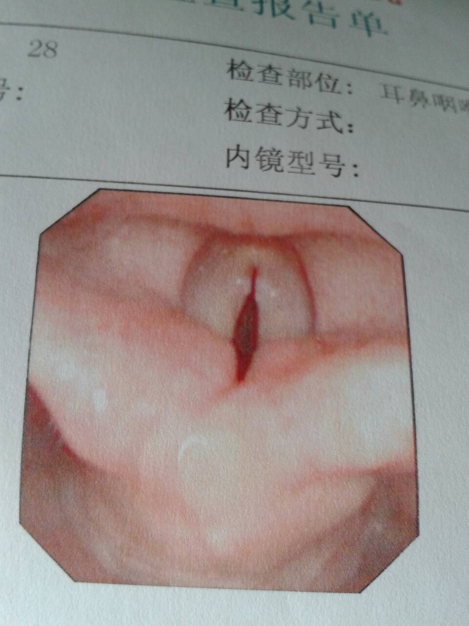 微型3D打印机助力医生精准修复声带