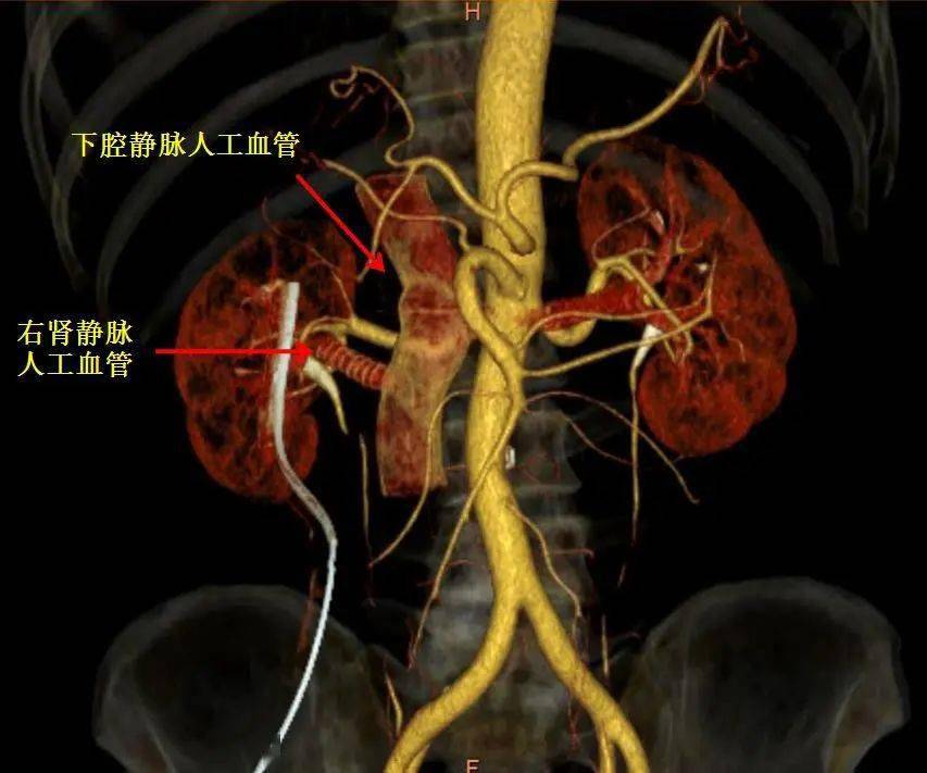 心脉医疗获得发明专利授权：“阻断装置以及人工血管系统”