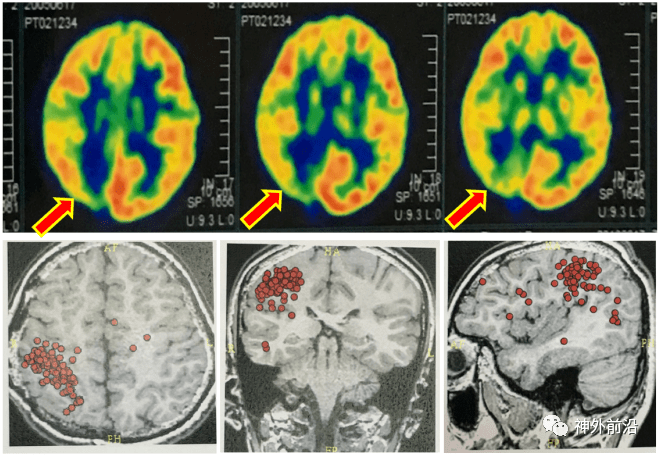 1月5日三博脑科涨停：脑科学，民营医院概念热股